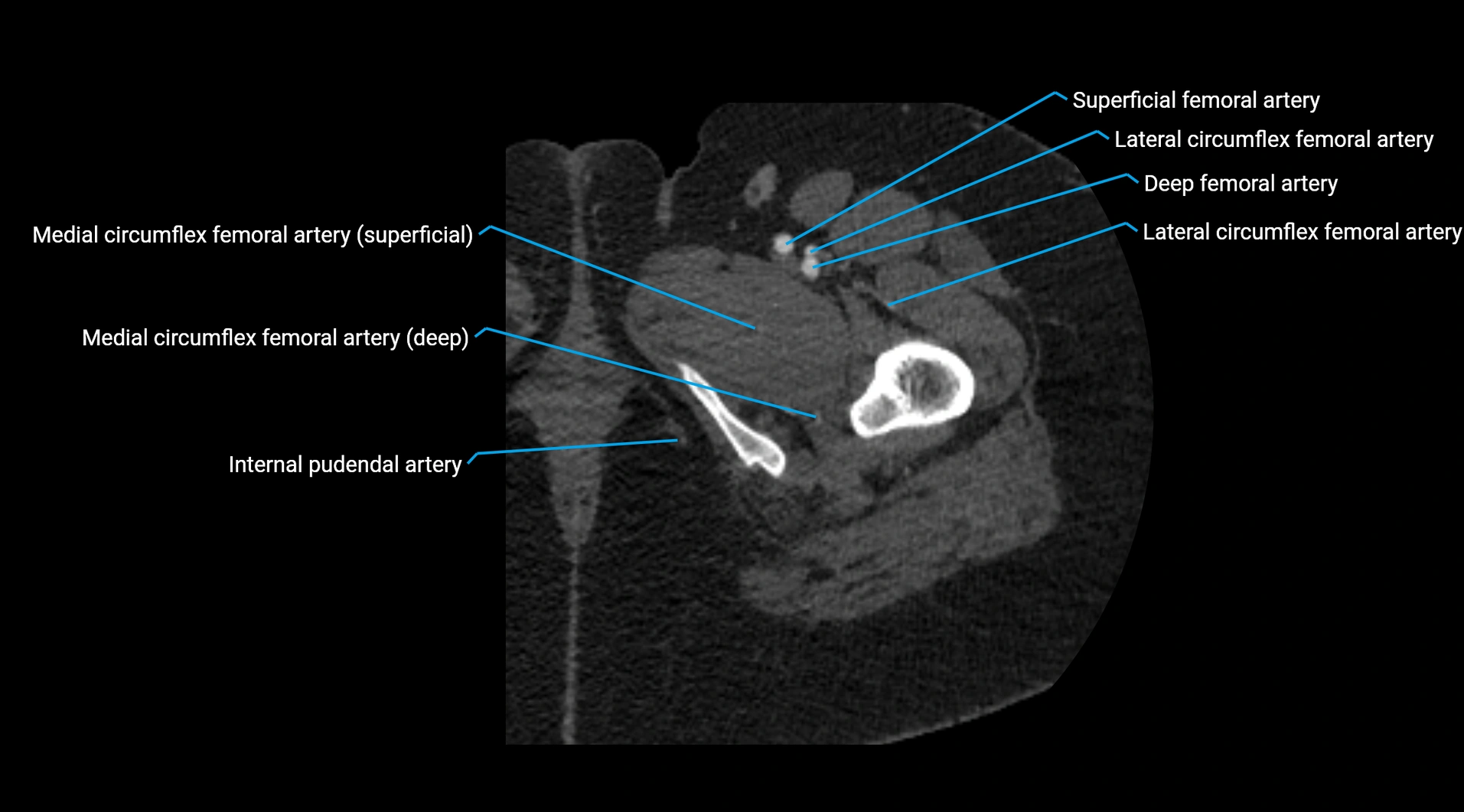 CTA lower limb cross sectional anatomy labelled image _76.webp